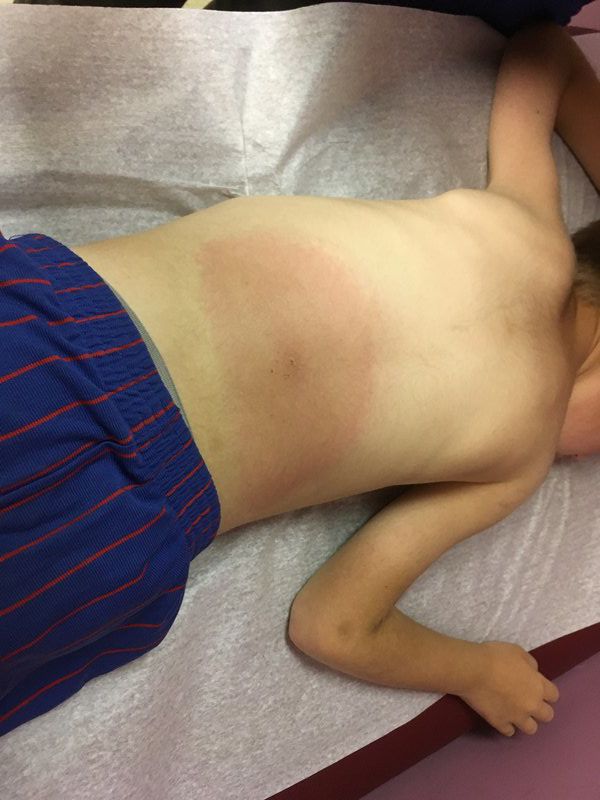 Pediatrician encounters tick bites, Lyme disease